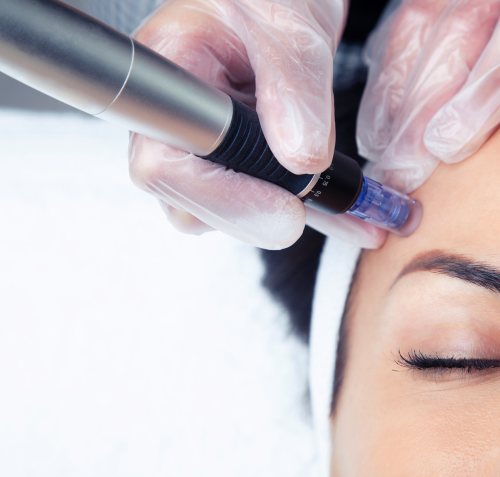 Microneedling